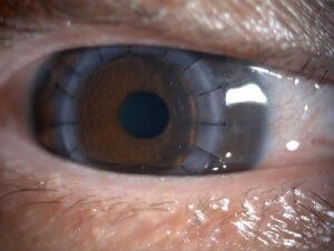 Corneal Transplant Image.