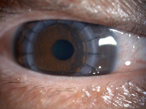 Corneal Transplant Image.