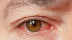 An eye condition called uveitis.