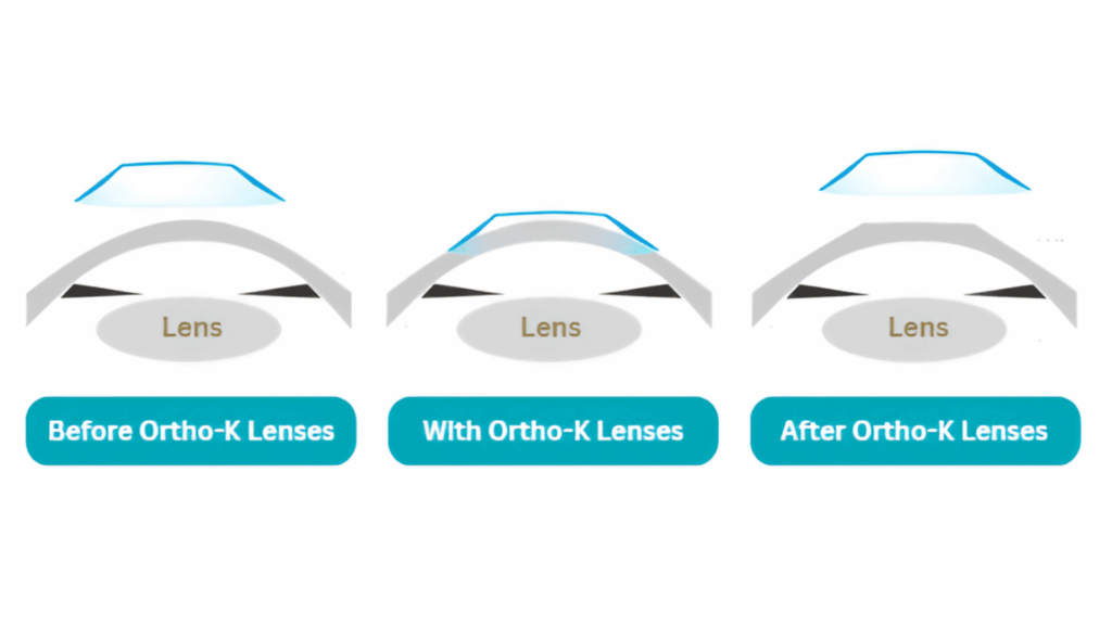 Ortho-K Process
